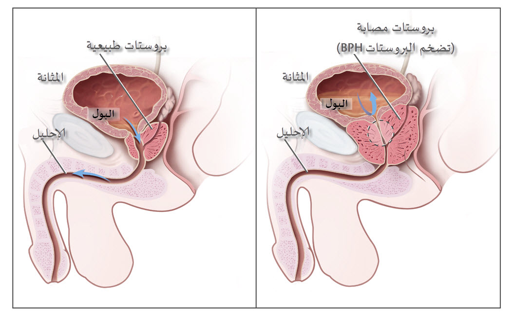 علاج تضخم غدة البروستاتا - اسباب تضخم البروستاتا 14370 1