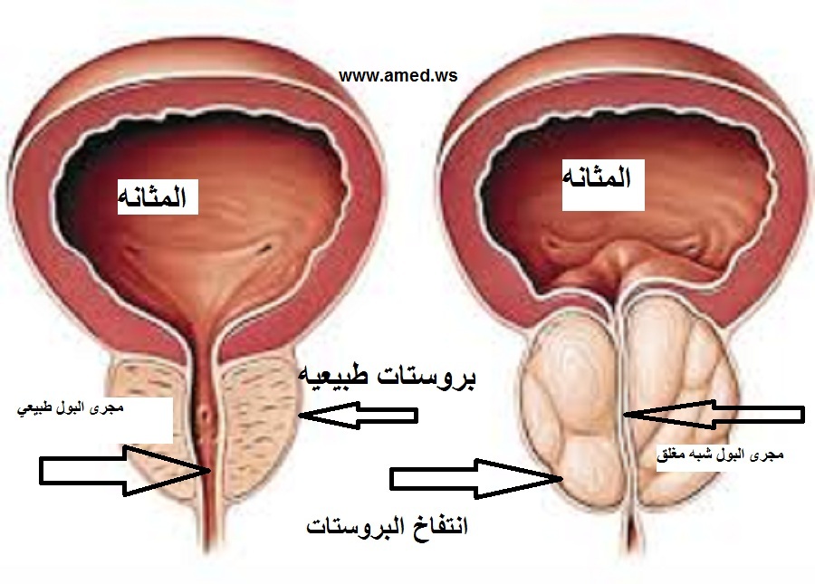 علاج تضخم غدة البروستاتا - اسباب تضخم البروستاتا 14370