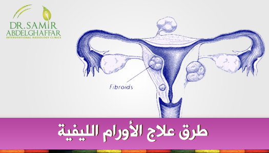 علاج الورم الليفي في الرحم بالقران - افضل علاج الورم الليفي في الرحم بالقران 11408