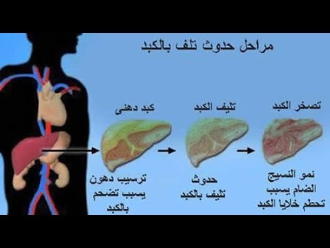 اعراض الدهون على الكبد - تكون الدهون علي الكبد واخلال الكبد بوظيفته 11837 1