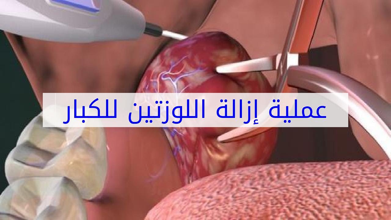 عملية لوز للكبار- حدث الاساليب لجراحه اللوز 12655