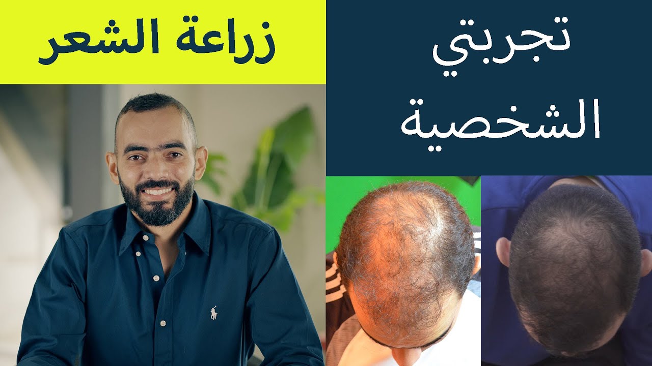 تجربتي زراعة الشعر - ما هي تجارب زراعه الشعر 14345 2