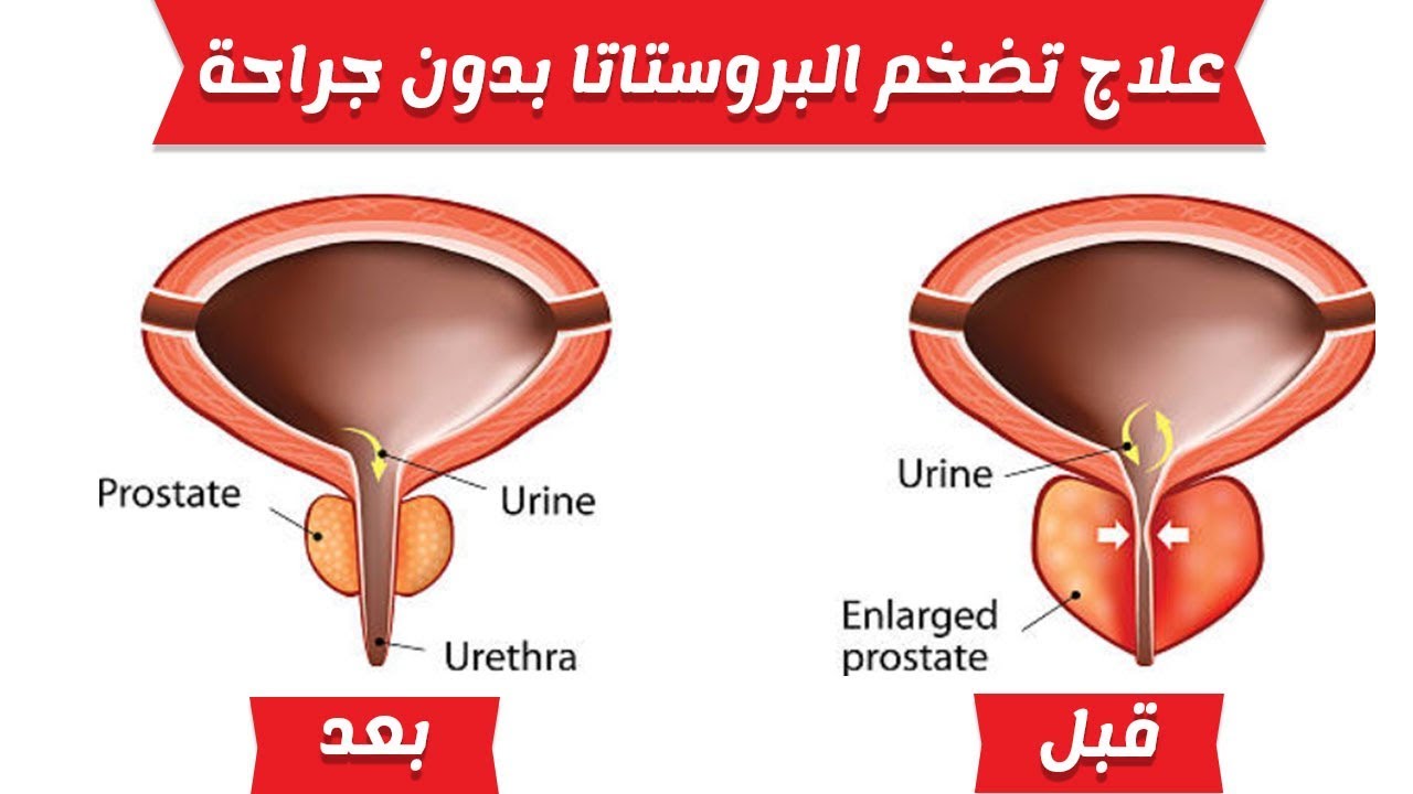 علاج تضخم غدة البروستاتا - اسباب تضخم البروستاتا 14370 2