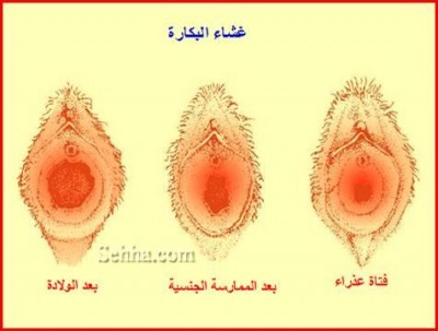 غشاء بكارة بالصور - غشاء البكاره لدى البنات 1735 4