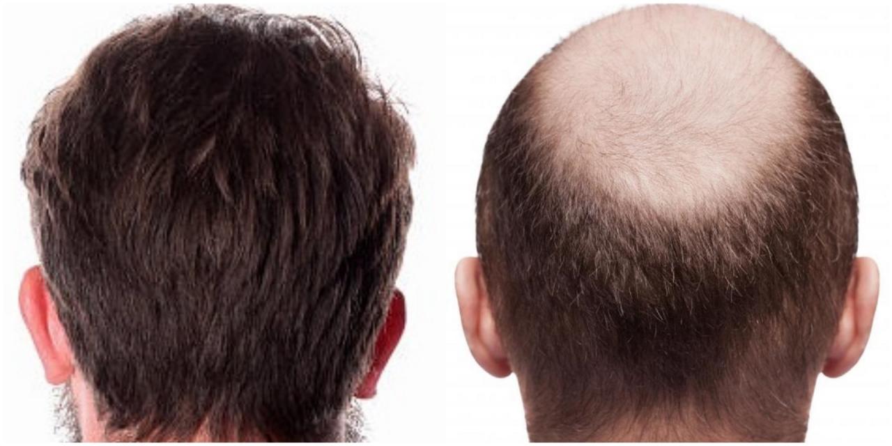 تجربتي زراعة الشعر , ما هي تجارب زراعه الشعر