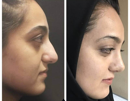 عمليات التجميل في ايران- معقول بايران عمليات تجميل 12658