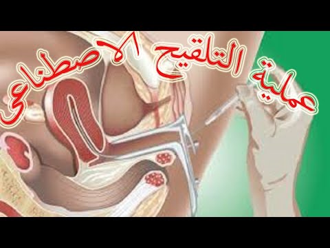 تجربتي بالتلقيح الصناعي , ماذا تعرف عن التلقيح الصناعي