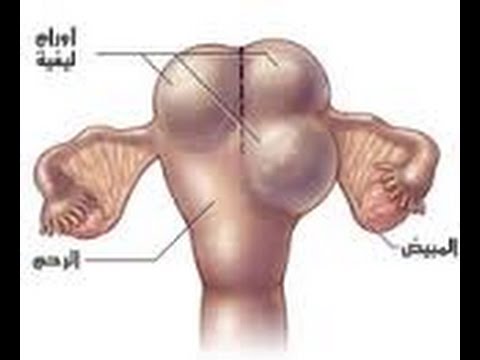 علاج الورم الليفي في الرحم بالقران - افضل علاج الورم الليفي في الرحم بالقران 11408