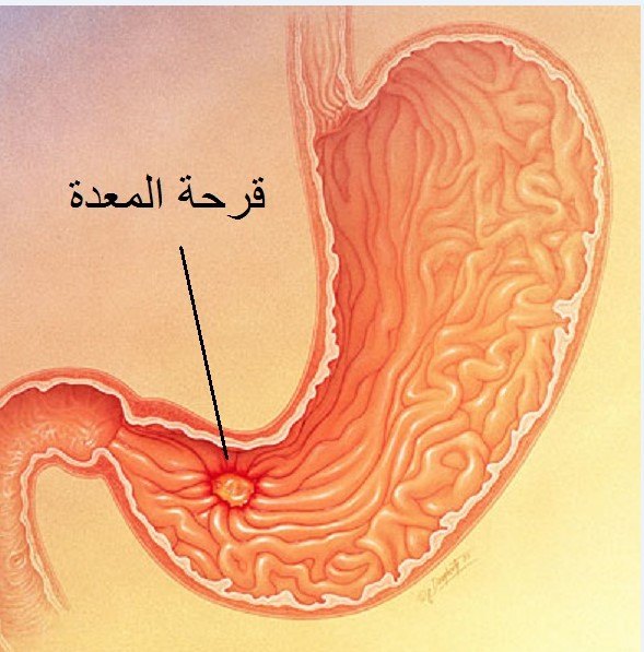 التدخين وقرحة المعدة , اسباب قرحة المعدة