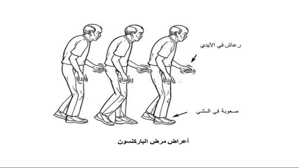 ما هو مرض باركنسون - الامراض المستعصيه علي الاطباء 11970 2