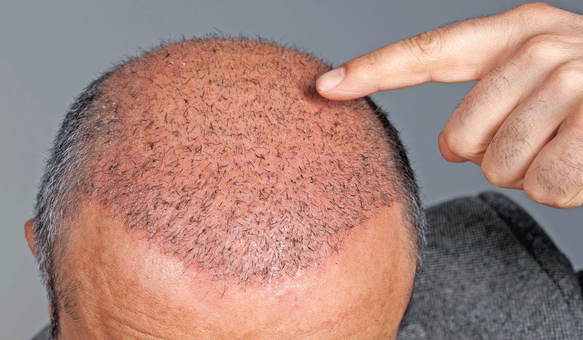 هل زراعة الشعر تسبب السرطان 12421 5