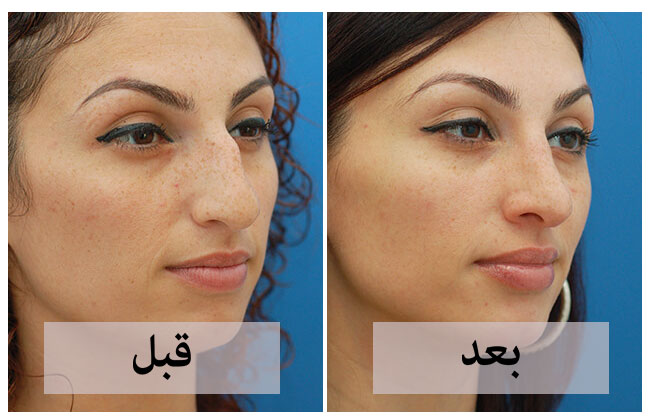 عمليات التجميل في ايران- معقول بايران عمليات تجميل 12658 2