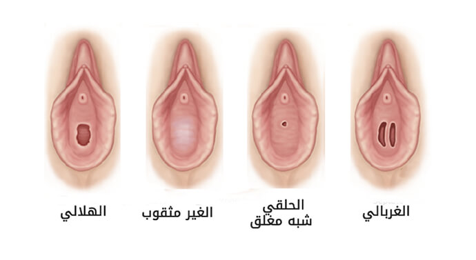 غشاء بكارة بالصور , غشاء البكاره لدى البنات